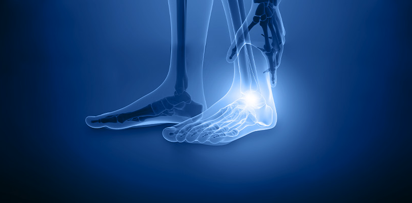 What is plantar fasciitis?