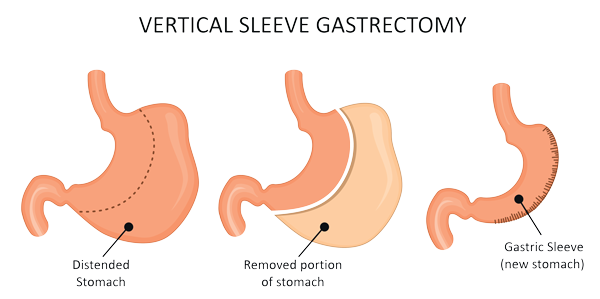 Vertical Sleeve Gastrectomy