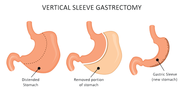 bariatric surgery