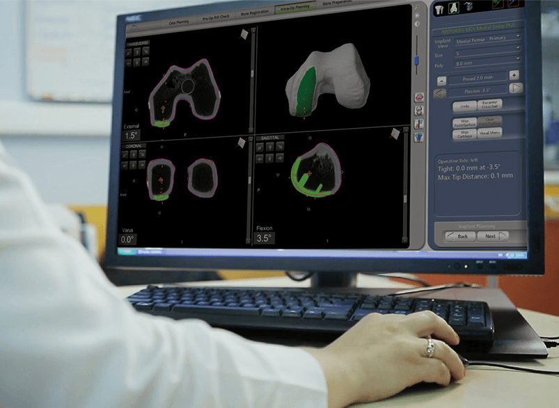 Mako partial knee CT-based surgical plan